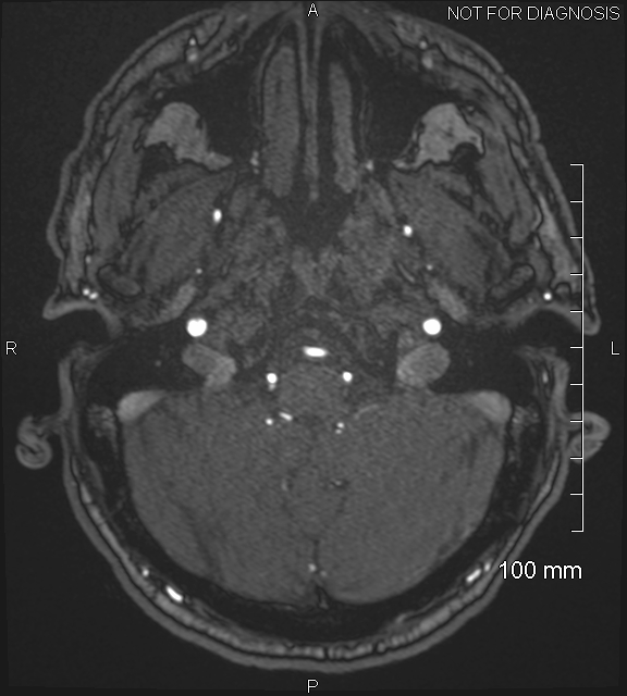Anterior cerebral artery aneurysm (Radiopaedia 80683-94127 Axial MRA 32).jpg