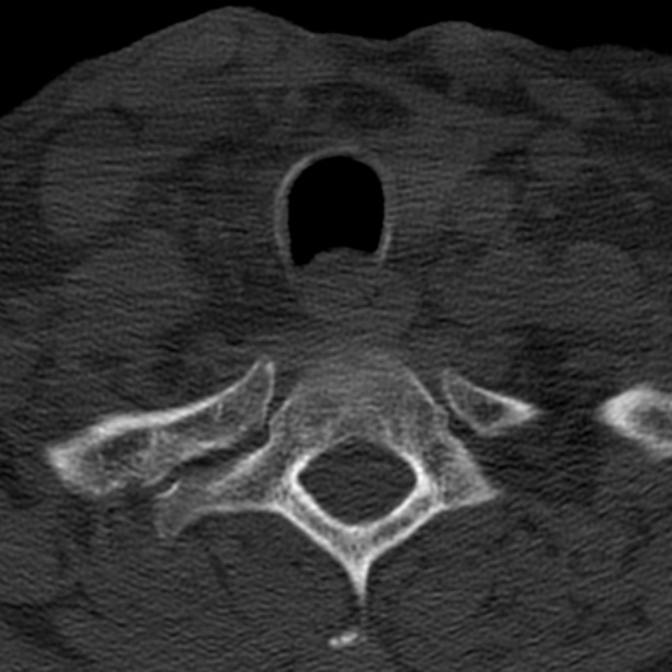 Anterior cervical postdiscectomy arthrodesis (Radiopaedia 32678-33646 Axial bone window 66).jpg