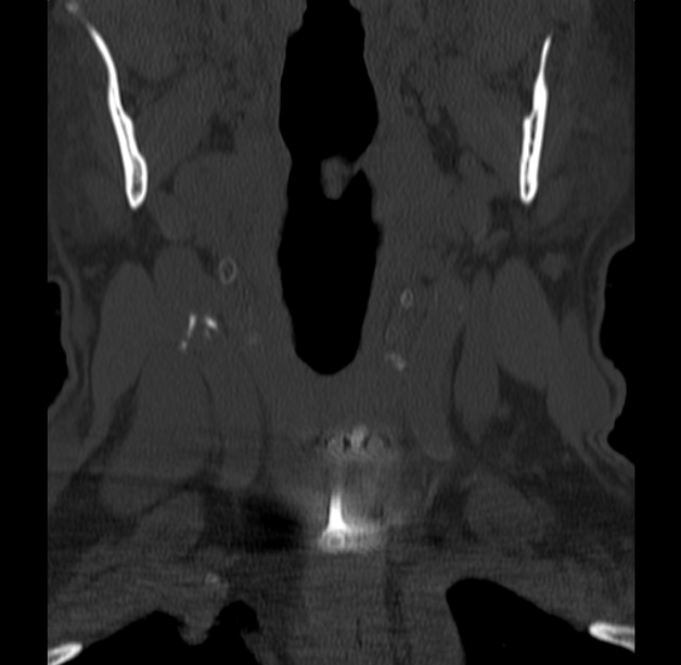 Anterior cervical postdiscectomy arthrodesis (Radiopaedia 32678-33646 Coronal bone window 7).jpg