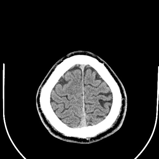 Anterior choroidal artery infarct (Radiopaedia 55106-61480 Axial non-contrast 56).jpg