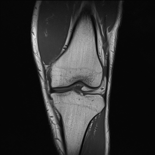 File:Anterior cruciate ligament full thickness tear (Radiopaedia 66268-75467 Coronal T1 8).jpg