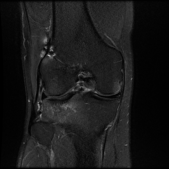 File:Anterior cruciate ligament graft tear and bucket-handle tear of medial meniscus (Radiopaedia 75867-87254 Coronal PD fat sat 15).jpg