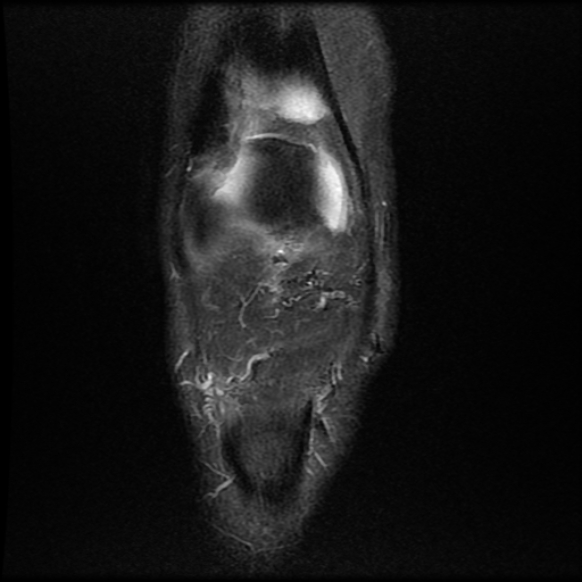 File:Anterior cruciate ligament graft tear and bucket-handle tear of medial meniscus (Radiopaedia 75867-87254 Coronal PD fat sat 5).jpg