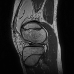 File:Anterior cruciate ligament tear - pediatric (Radiopaedia 62152-70260 Sagittal PD 132).jpg