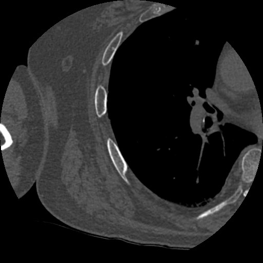 Anterior glenohumeral dislocation with Hill-Sachs lesion (Radiopaedia 62877-71249 Axial bone window 101).jpg