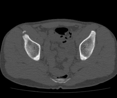 Anterior inferior iliac spine avulsion fracture (Radiopaedia 81312-94999 Axial bone window 46).jpg