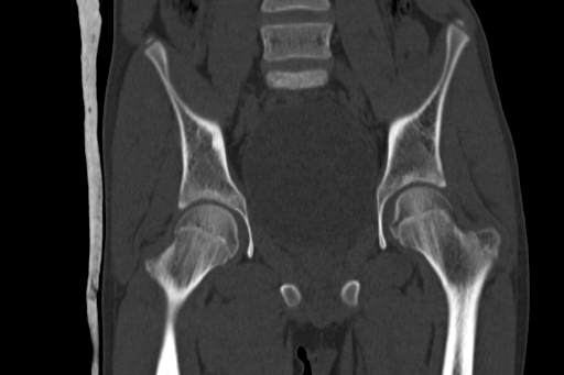 Anterior inferior iliac spine avulsion injury (Radiopaedia 88666-105376 Coronal bone window 35).jpg
