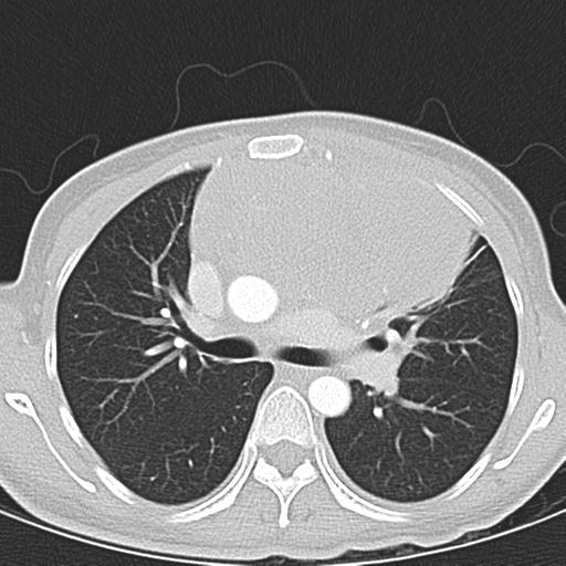 Anterior mediastinal lymphoma (Radiopaedia 29556-30061 Axial lung window 22).jpg