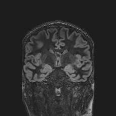 Anterior temporal encephalocele (Radiopaedia 82624-96808 Coronal FLAIR 24).jpg