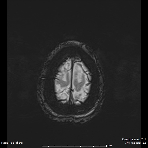 File:Anterior temporal lobe perivascular space (Radiopaedia 88283-104914 Axial SWI 64).jpg