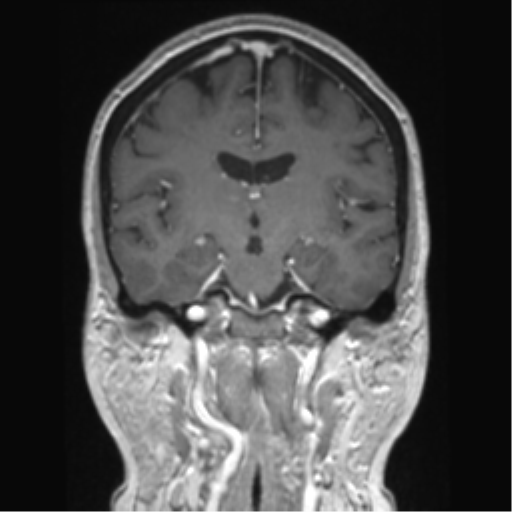 Anterior temporal pole cysts (Radiopaedia 46629-51102 Coronal T1 C+ 88).png