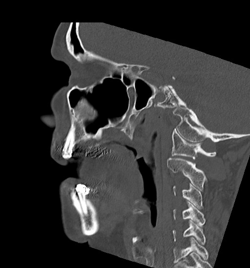 Anterior temporomandibular joint dislocation (Radiopaedia 59430-66784 B 24).jpg