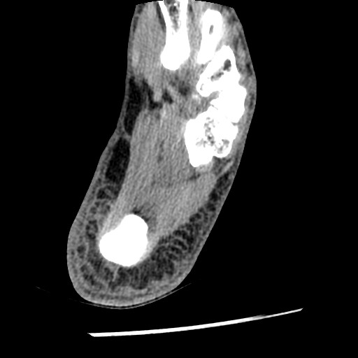 Anterior tibial artery false aneurysm (Radiopaedia 88984-105809 A 218).jpg