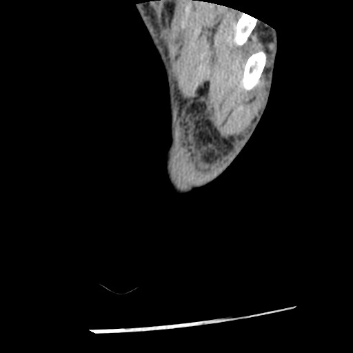 Anterior tibial artery false aneurysm (Radiopaedia 88984-105809 A 260).jpg
