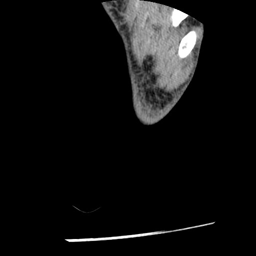 Anterior tibial artery false aneurysm (Radiopaedia 88984-105809 A 264).jpg