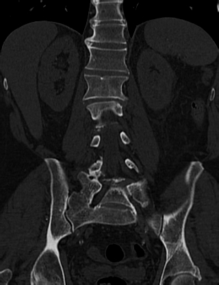 Anterior vertebral scalloping (abdominal aortic aneurysm) (Radiopaedia 66744-76067 Coronal bone window 43).jpg