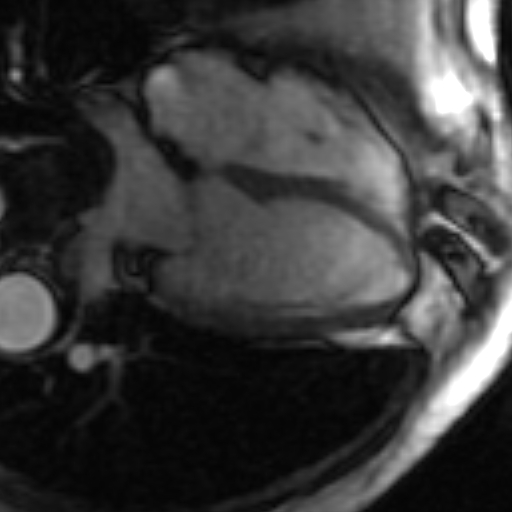 File:Anteroseptal hypokinesia after myocardial infarction (Radiopaedia 15978-15633 4 chamber view SSFE 29).jpg