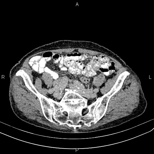 File:Aortic aneurysm and Lemmel syndrome (Radiopaedia 86499-102554 Axial C+ delayed 60).jpg