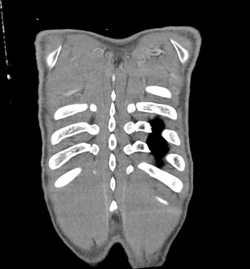 Aortic coarctation with aneurysm (Radiopaedia 74818-85828 C 111).jpg