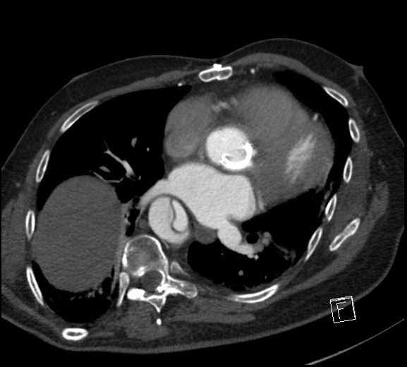 Aortic dissection (CTPA) (Radiopaedia 75506-86750 A 56).jpg