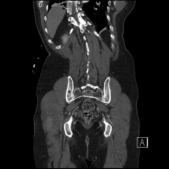 File:Aortic dissection (CTPA) (Radiopaedia 75506-86750 F 62).jpg