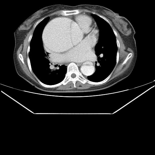 File:Aortic dissection (Radiopaedia 25350-25604 C 26).jpg