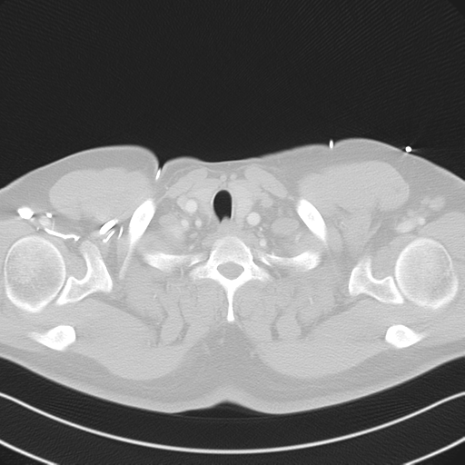 File:Aortic dissection (Radiopaedia 50763-56234 Axial lung window 9).png