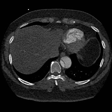 File:Aortic dissection (Radiopaedia 57969-64959 A 241).jpg