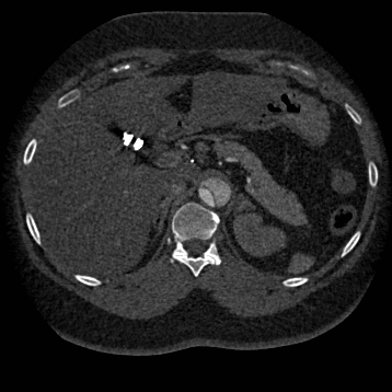 Aortic dissection (Radiopaedia 57969-64959 A 325).jpg