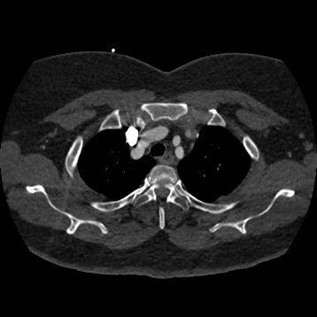 Aortic dissection (Radiopaedia 57969-64959 A 65).jpg