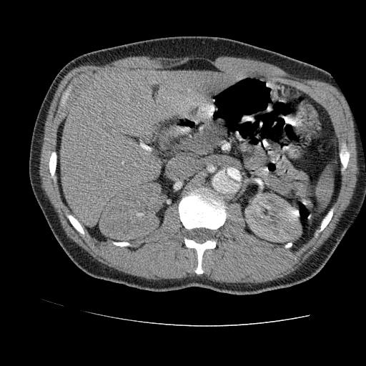 File:Aortic dissection - Stanford A -DeBakey I (Radiopaedia 28339-28587 B 121).jpg