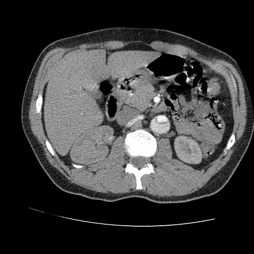 File:Aortic dissection - Stanford A -DeBakey I (Radiopaedia 28339-28587 B 125).jpg