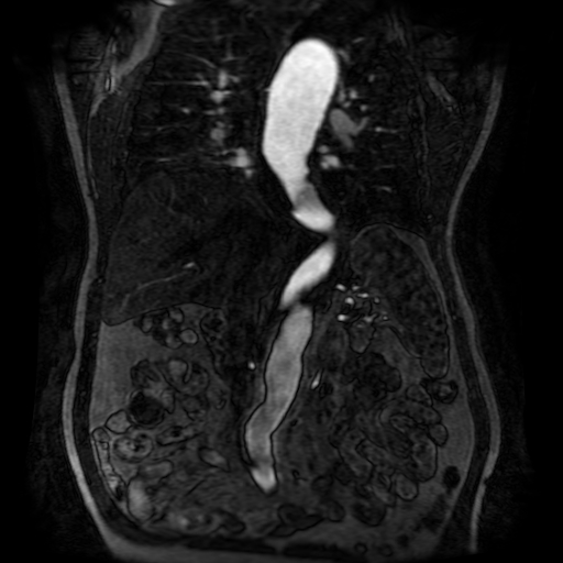 Aortic dissection - Stanford A - DeBakey I (Radiopaedia 23469-23551 D 131).jpg