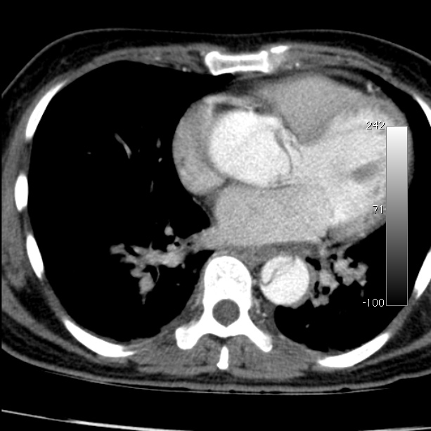 Aortic dissection - Stanford type A (Radiopaedia 29247-29659 A 49).jpg