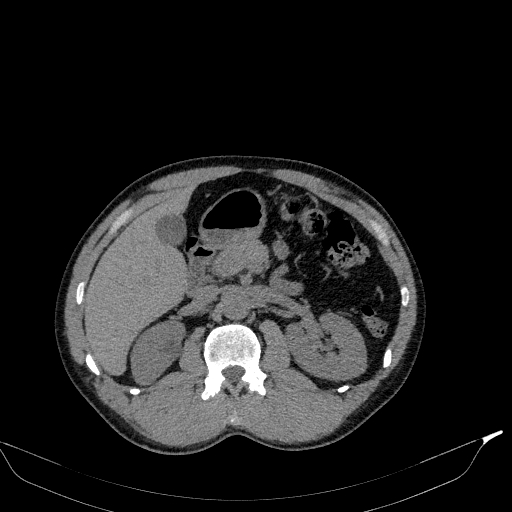 Aortic dissection - Stanford type A (Radiopaedia 83418-98500 Axial non-contrast 50).jpg