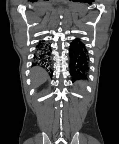 File:Aortic dissection - Stanford type B (Radiopaedia 73648-84437 B 101).jpg