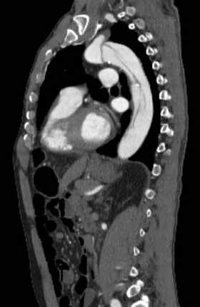 File:Aortic dissection - Stanford type B (Radiopaedia 73648-84437 C 61).jpg