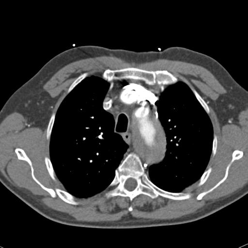 Aortic intramural hematoma (Radiopaedia 31139-31838 B 24).jpg