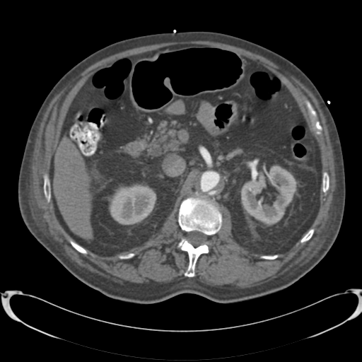 Aortic intramural hematoma (Radiopaedia 34260-35540 B 49).png