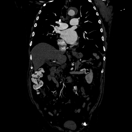 Aortic intramural hematoma (Radiopaedia 34260-35540 C 42).png