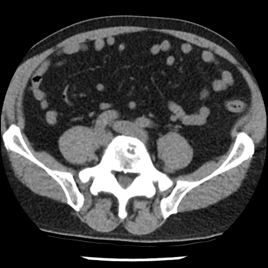 File:Aortic intramural hematoma (type B) (Radiopaedia 79323-92387 Axial non-contrast 87).jpg