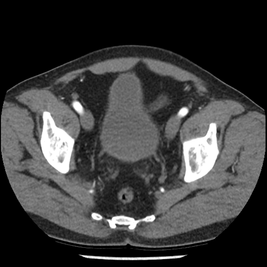Aortic intramural hematoma (type B) (Radiopaedia 79323-92387 B 105).jpg