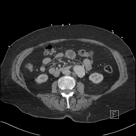 Aortic intramural hematoma with dissection and intramural blood pool (Radiopaedia 77373-89491 E 39).jpg