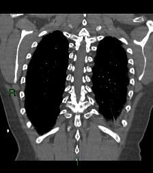 File:Aortic valve endocarditis (Radiopaedia 87209-103485 D 14).jpg