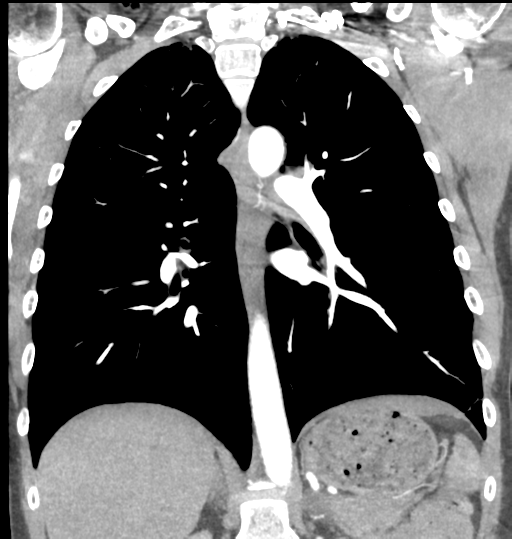 File:Aortic valve non-coronary cusp thrombus (Radiopaedia 55661-62189 C 47).png