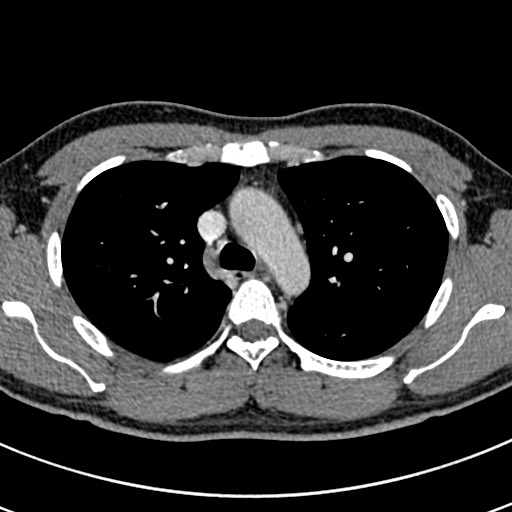 Apical lung mass mimic - neurogenic tumor (Radiopaedia 59918-67521 A 27).jpg