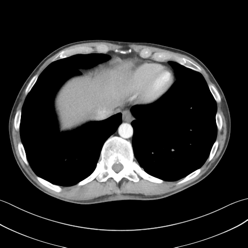 File:Apical pleural calcification (Radiopaedia 46141-50499 Axial C+ delayed 57).png