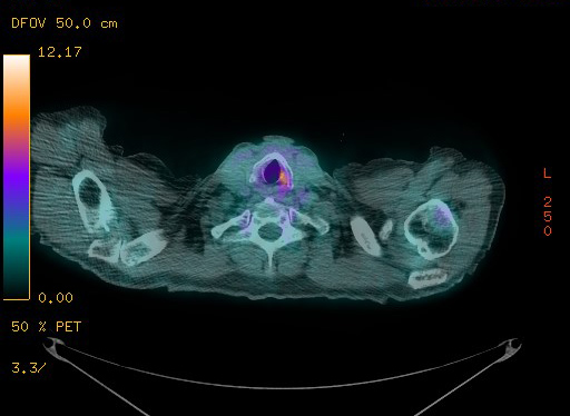 Appendiceal adenocarcinoma complicated by retroperitoneal abscess (Radiopaedia 58007-65041 Axial PET-CT 26).jpg