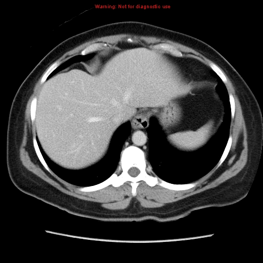 File:Appendiceal mucinous cystadenoma (Radiopaedia 8263-9111 Axial liver window 16).jpg