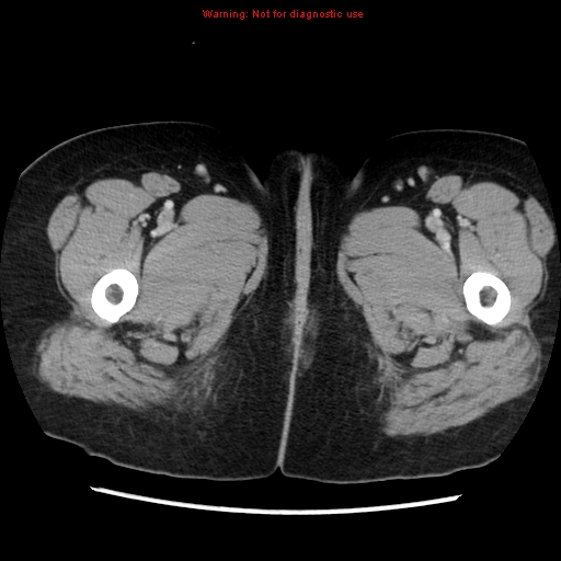 Appendiceal mucinous cystadenoma (Radiopaedia 8263-9111 Axial liver window 91).jpg